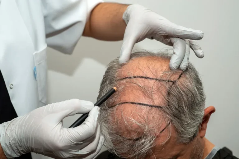 doctor marking hairline on patient’s scalp before hair transplant procedure