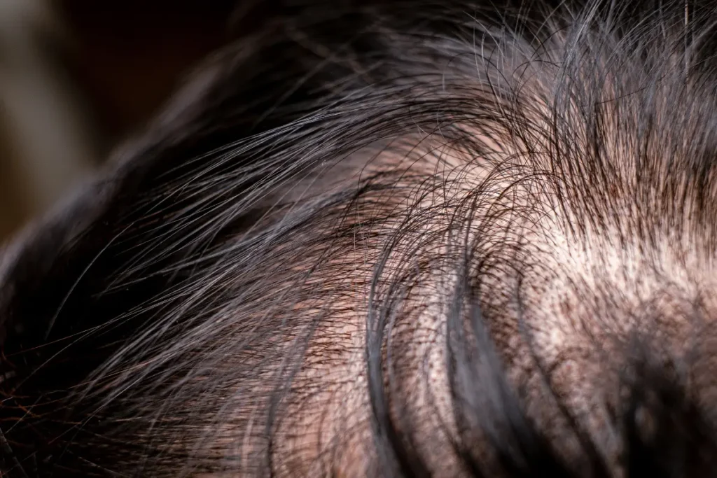 close-up of scalp showing diffuse thinning consistent with Ludwig hair loss classification