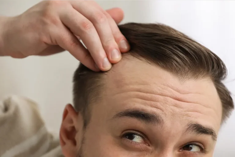 close-up of man checking his receding hairline with his hand