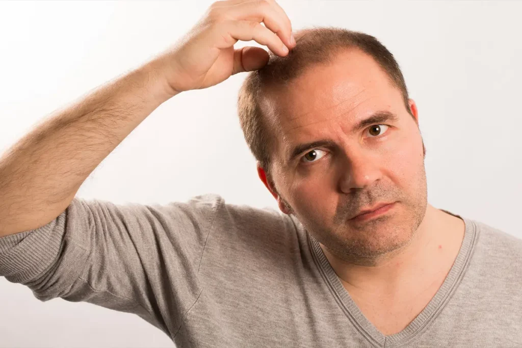 middle-aged man examining his receding hairline, showing signs of traction alopecia