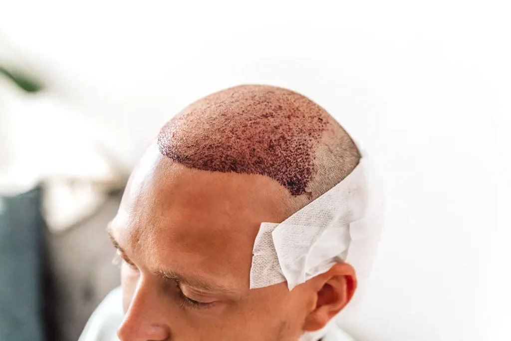 close-up of a man's scalp immediately after hair transplant surgery with visible grafts and bandages
