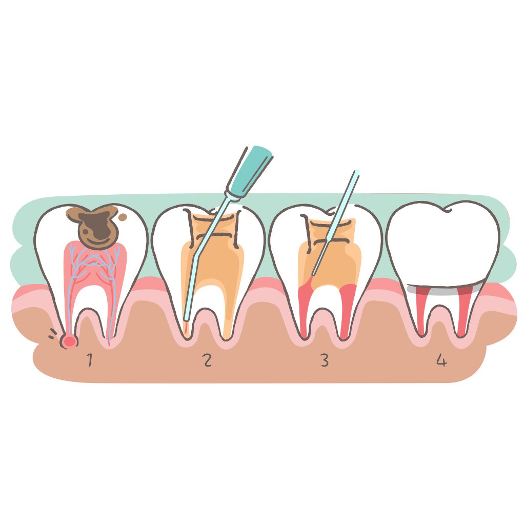 root canal treatment 1.png