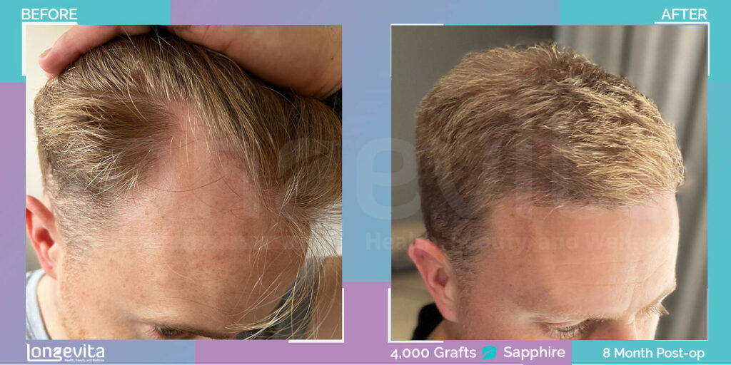4000 graft fue hair transplant results