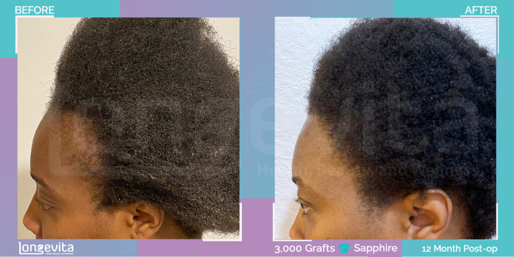 afro female sapphire fue hair transplant results