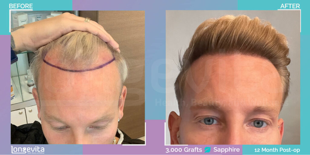 sapphire fue hair transplant before and after images 3000 grafts male patient