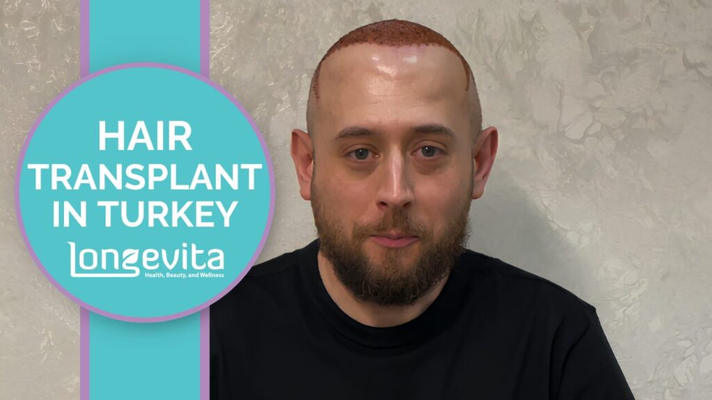 Thomas's hair transplant Turkey