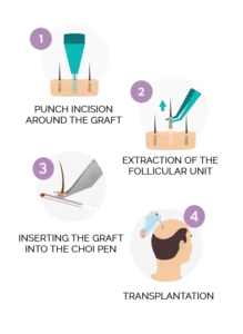 dhi hair transplant turkey