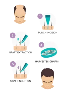 fue hair transplant turkey