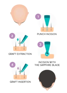 sapphire fue hair transplant turkey
