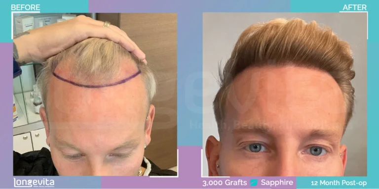 sapphire hair transplant uk before after 3000 grafts blonde hair