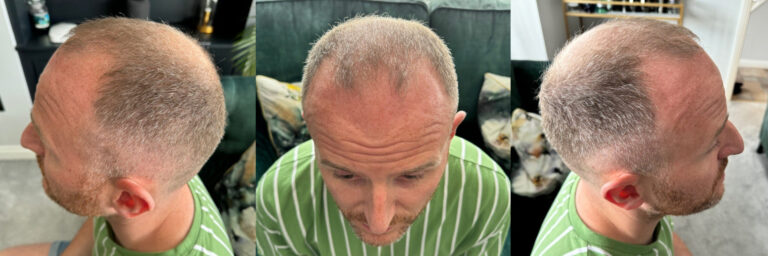 hair transplant patient before photos 2 glenn