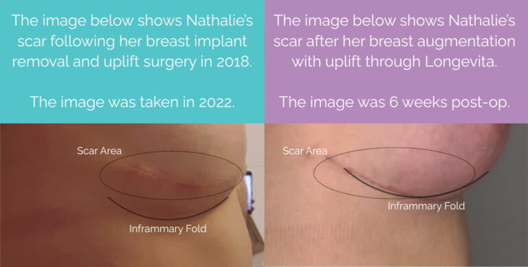 Nathalie Scar Revision Image Before & After