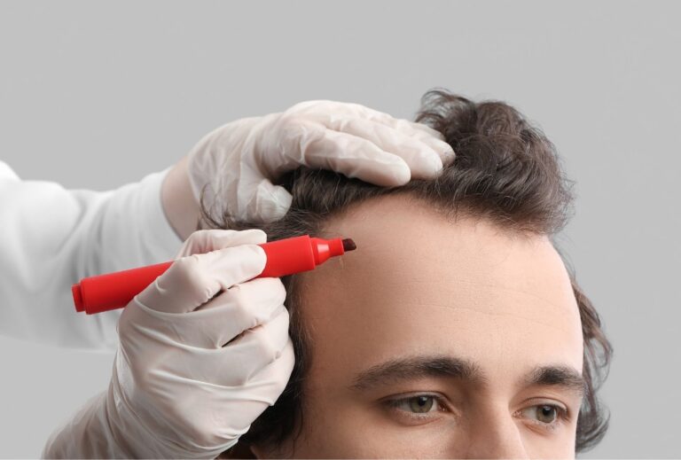 dhi hair transplant uk