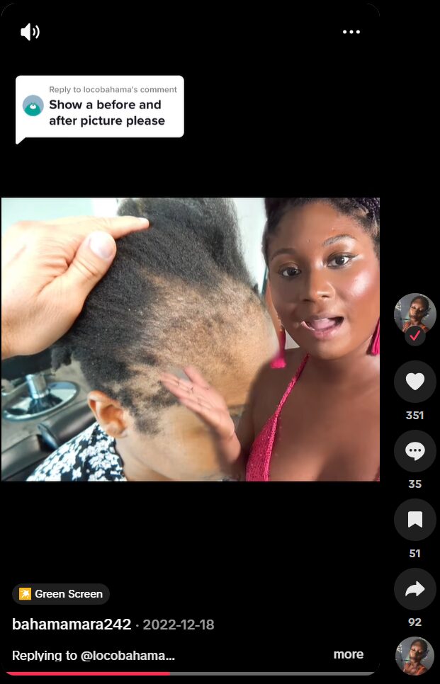 maradona tiktok hair transplant before video