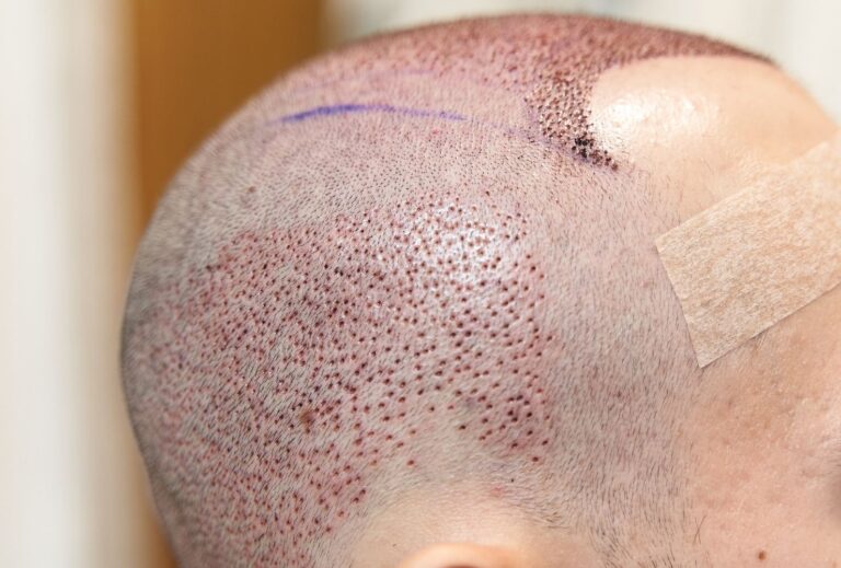 sapphire fue hair transplant uk