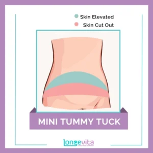 1 Mini Tummy Tuck skin elevated & cut out