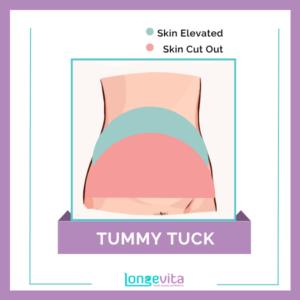 1 Tummy Tuck skin elevated & cut out