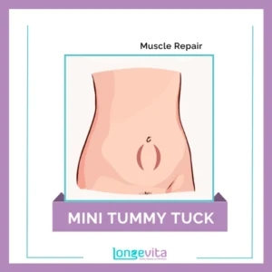 2 Mini Tummy Tuck Muscle Repair