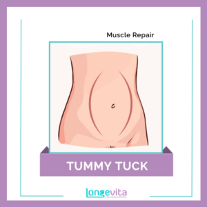 2 Tummy Tuck Muscle Repair