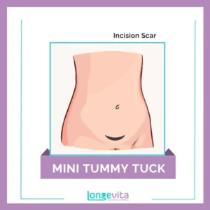 3 Mini Tummy Tuck Incision Scar