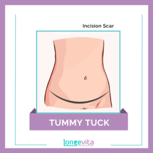 3 Tummy Tuck Incision Scar