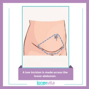 A low incision is made across the lower abdomen.