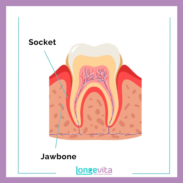 Jawbone socket extraction
