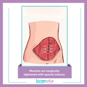 Muscles are surgically tightened with special sutures.