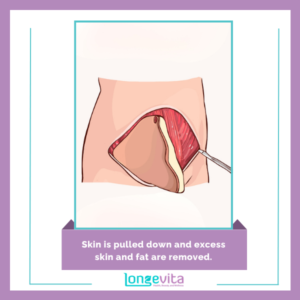Skin is pulled down and excess skin and fat are removed.