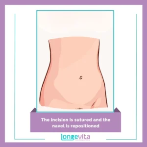 The Incision is sutured and the navel is repositioned