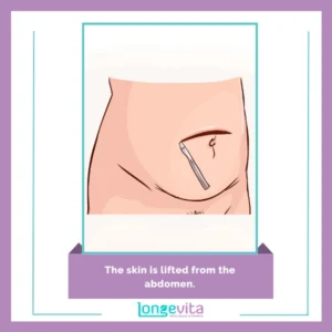 The skin is lifted from the abdomen.