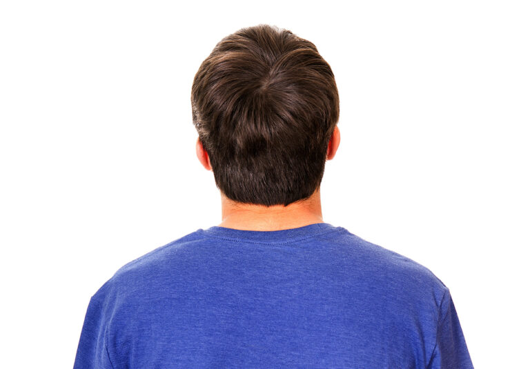 back of mans head donor area