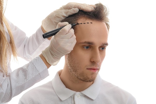 hair transplant hairline design marker