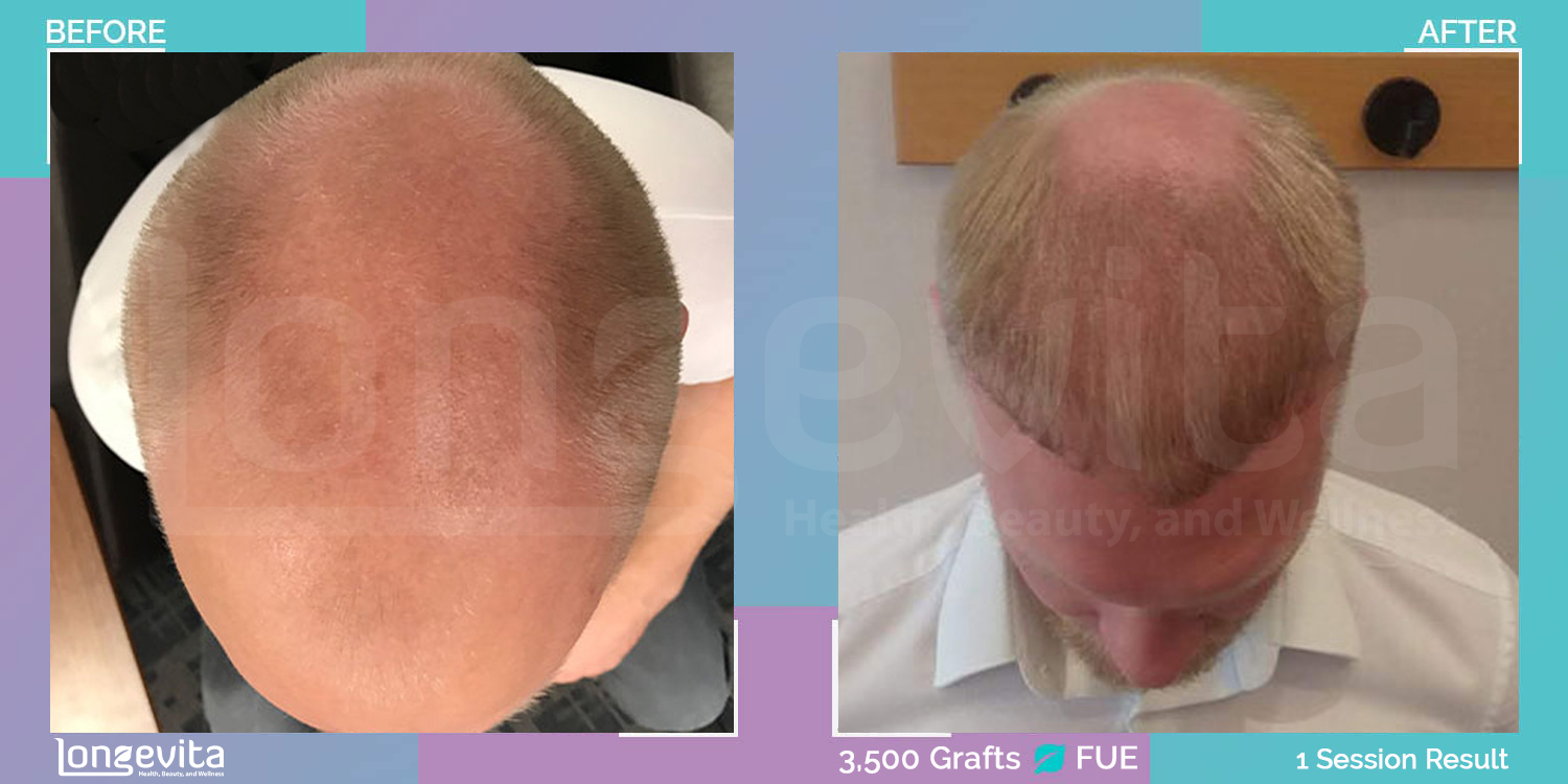 FUE hair transplant before and after, 3500 grafts, 4 zones covered