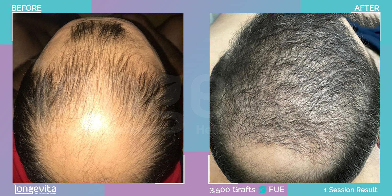 FUE hair transplant before and after, 3500 grafts, 5 zones covered, 40s male patient