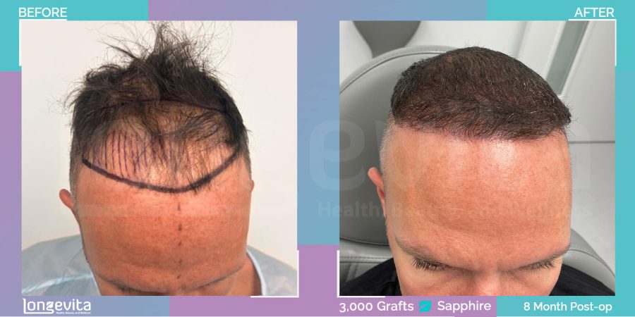 SAPPHIRE hair transplant before and after, 3000 grafts, 4 zones covered