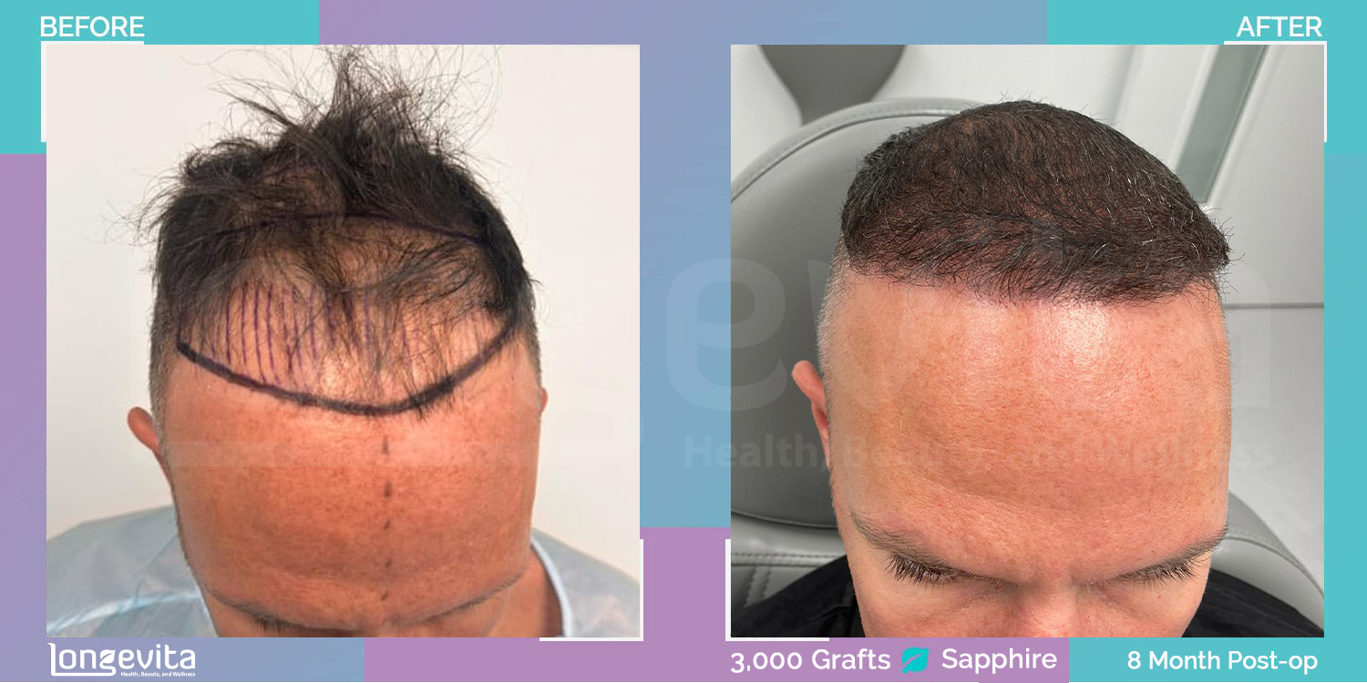 SAPPHIRE hair transplant before and after, 3000 grafts, 4 zones covered