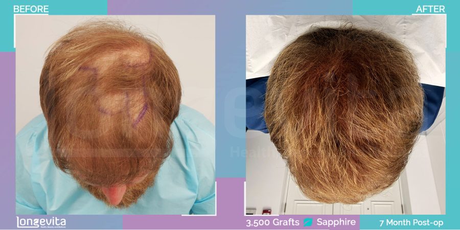 SAPPHIRE hair transplant before and after, 3500 grafts, 4 zones covered