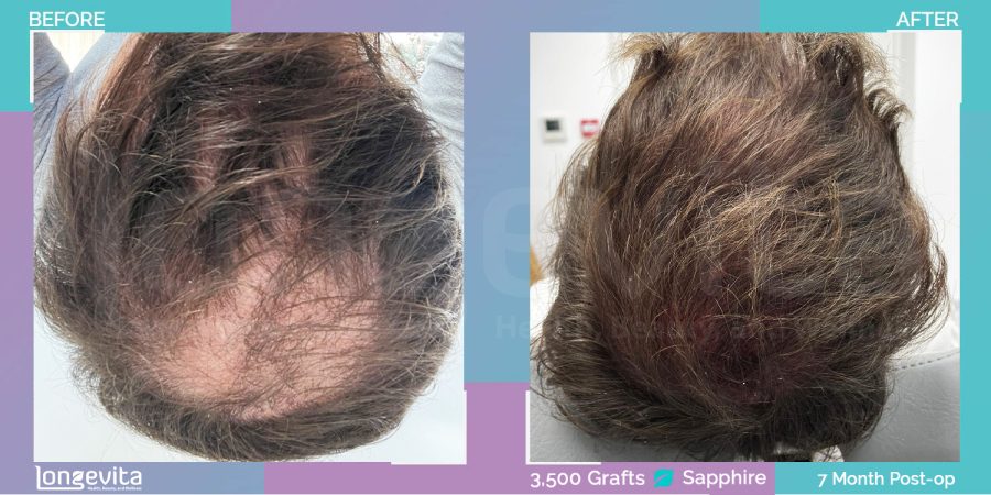 SAPPHIRE hair transplant before and after, 3500 grafts, 4 zones covered