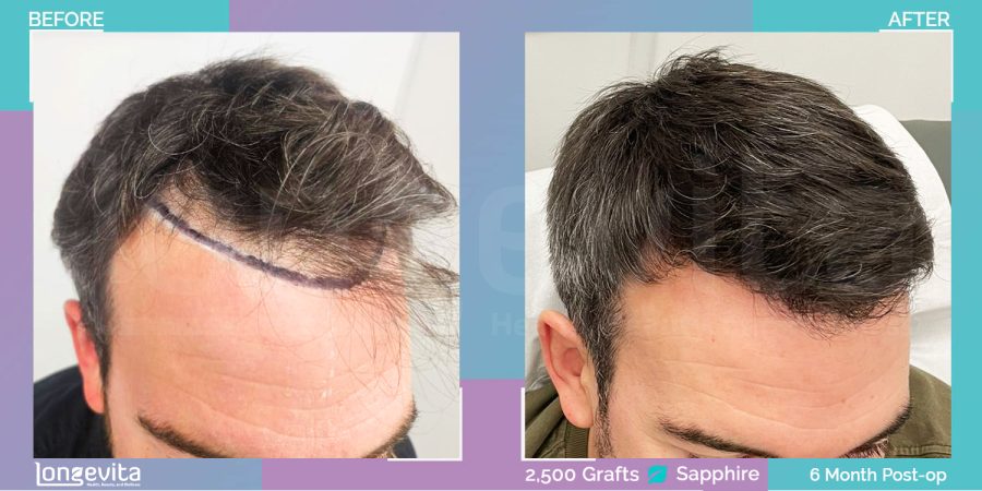 SAPPHIRE hair transplant before and after, 2500 grafts, 3 zones covered