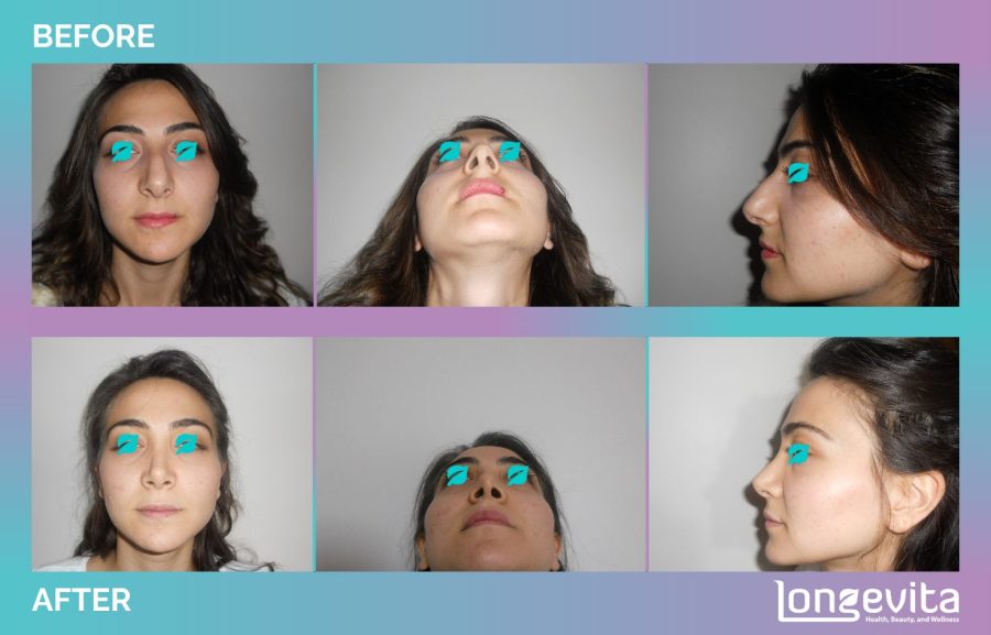 Rhinoplasty before and after, Face
