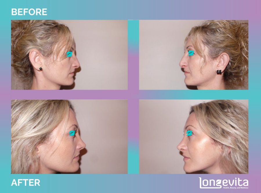 Rhinoplasty before and after, Face