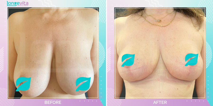 Breast Reduction before and after, Breast