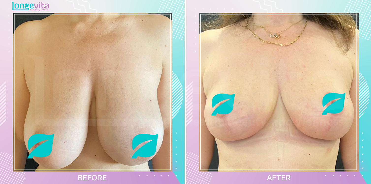Breast Reduction before and after, Breast