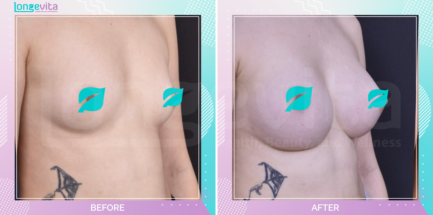 Breast Enlargement before and after, Breast