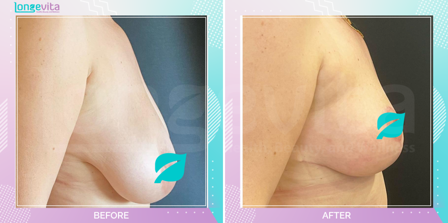 Breast Reduction before and after, Breast