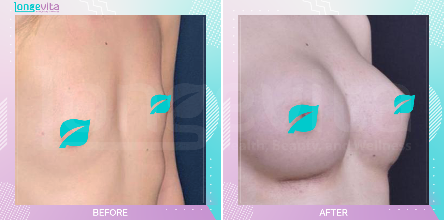 Breast Enlargement before and after, Breast