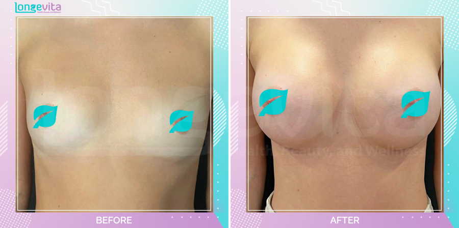 Breast Enlargement before and after, Breast