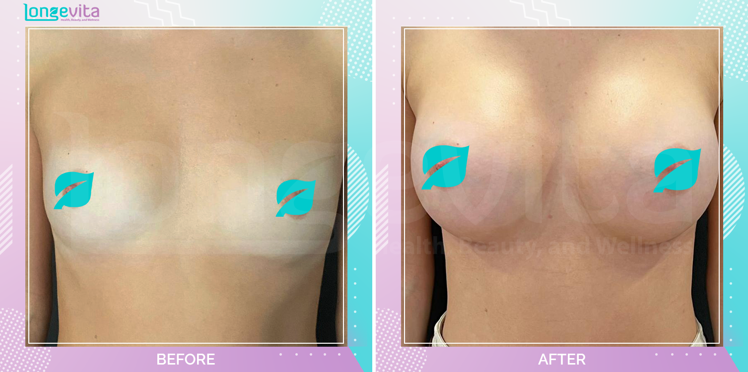 Breast Enlargement before and after, Breast