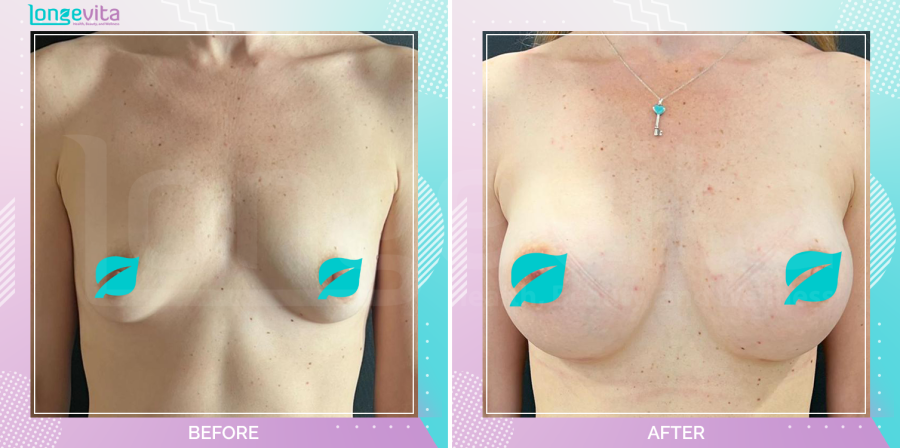 Breast Enlargement before and after, Breast